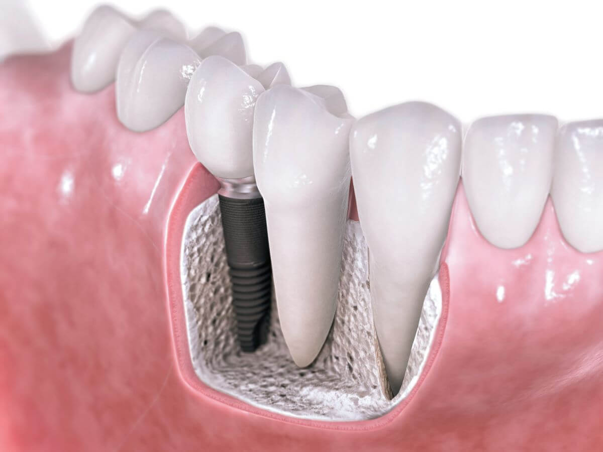 Dental implants removal-05