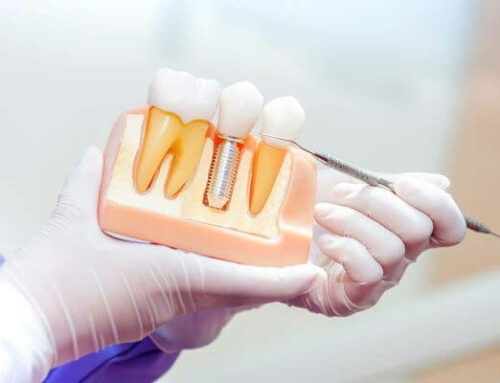 What to Know About removal of dental implants？