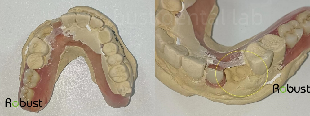 Add arylic teeth to the existing partial