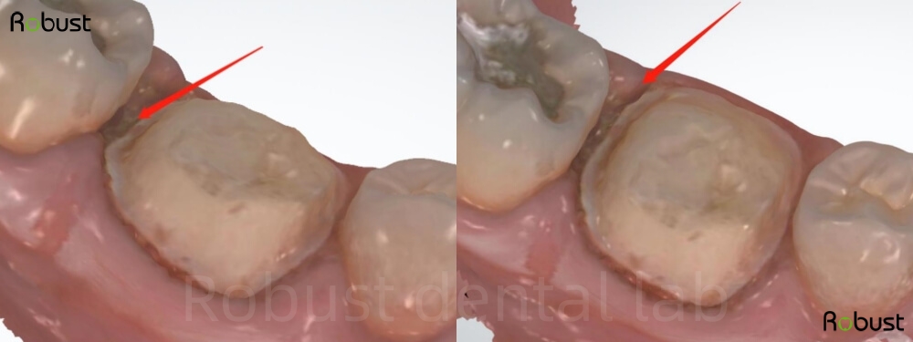 Clear margin for dental crown