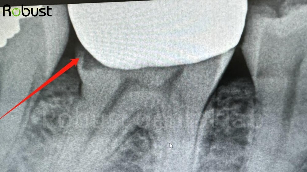 Xray of the dental crown