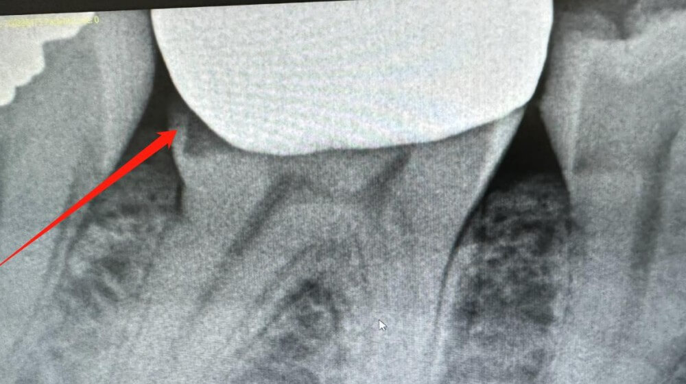 Xray-of-the-dental-crown