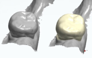 comparing 2 dental crowns