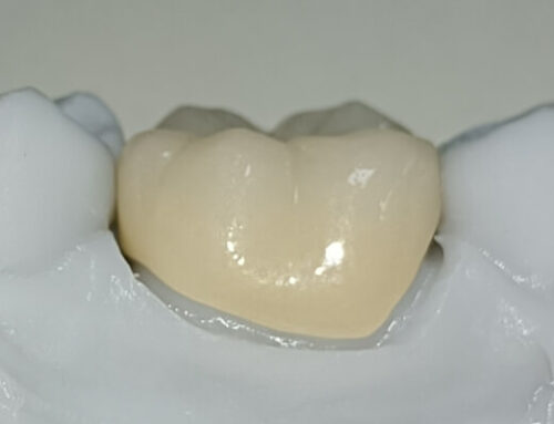How to deal with open margins for dental crowns?