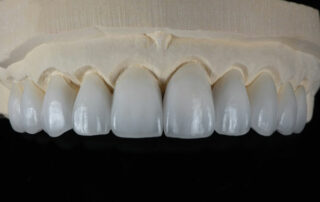 emax dental crowns and veneers