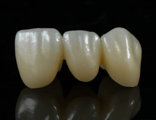 How do we ensure easy fitting for your dental crowns and bridges?