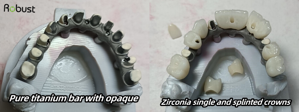 Titanium bar and zirconia porcelain crowns