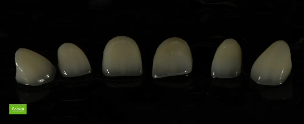 Emax crowns front teeth