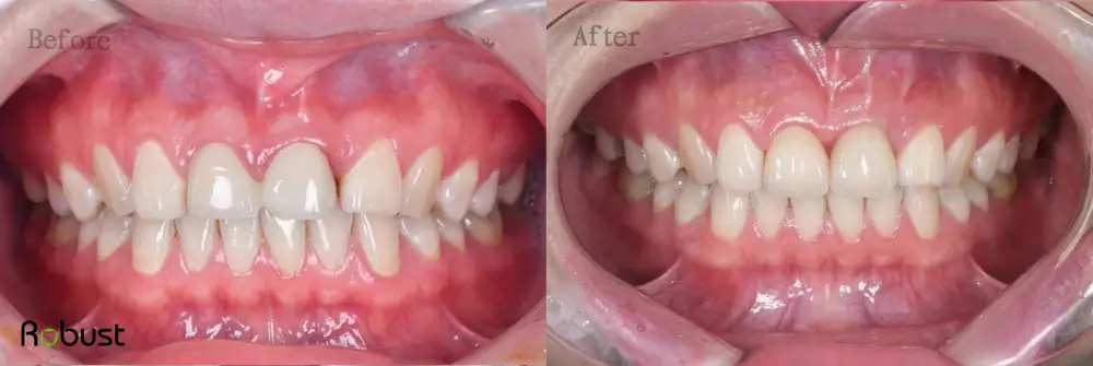emax crowns before and after